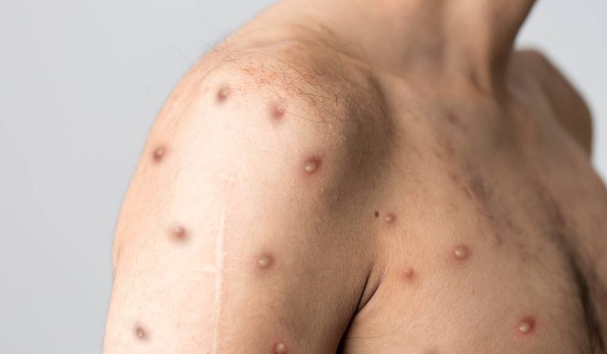 ShoulderWithMonkeypox